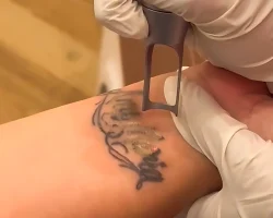 Tattoo Removal