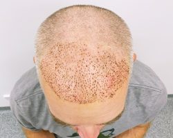 Hair Transplant