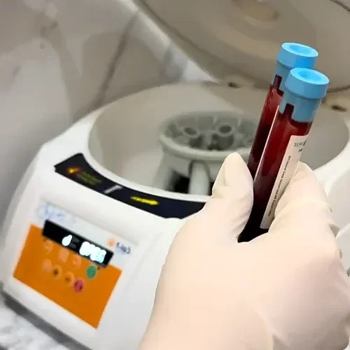 PRP Skin Treatment